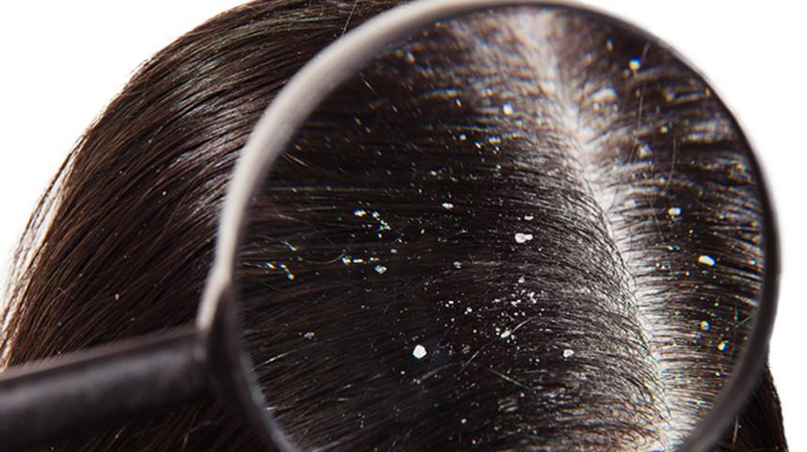 The Best All-Natural Routine to Fight Dandruff (Without Harsh Chemicals)