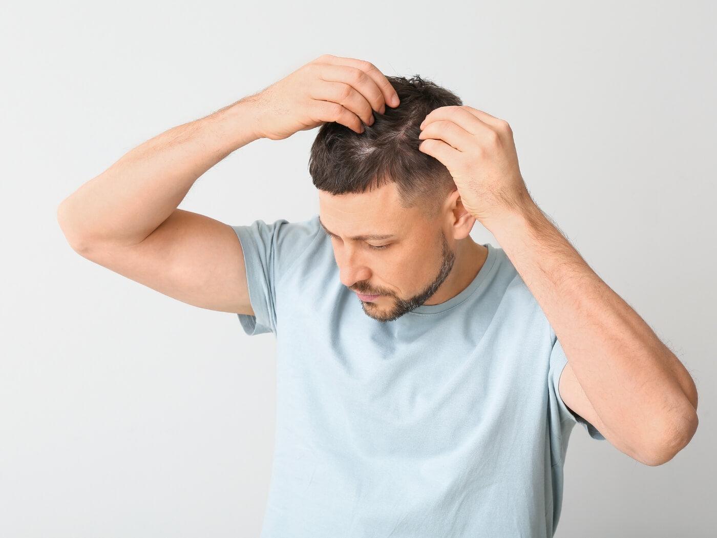 Hair Loss in Men: Causes and Prevention Tips - OBRO