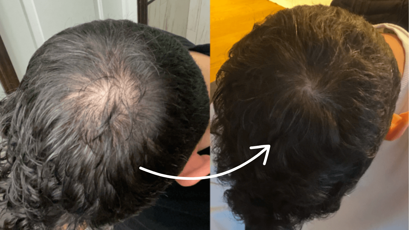 Experiencing Male Pattern Hair Loss