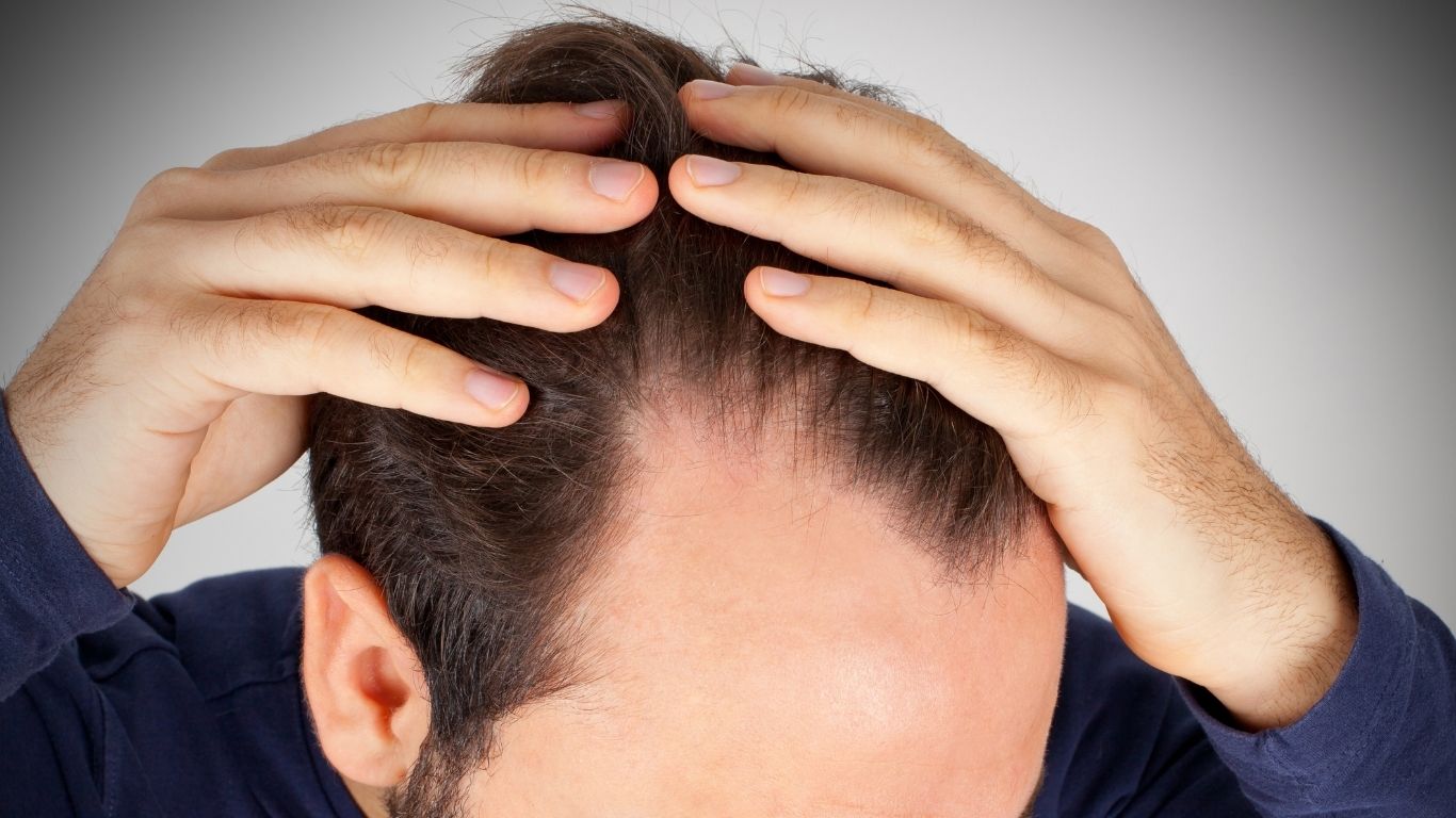 What Causes Receding Hairline in Men?