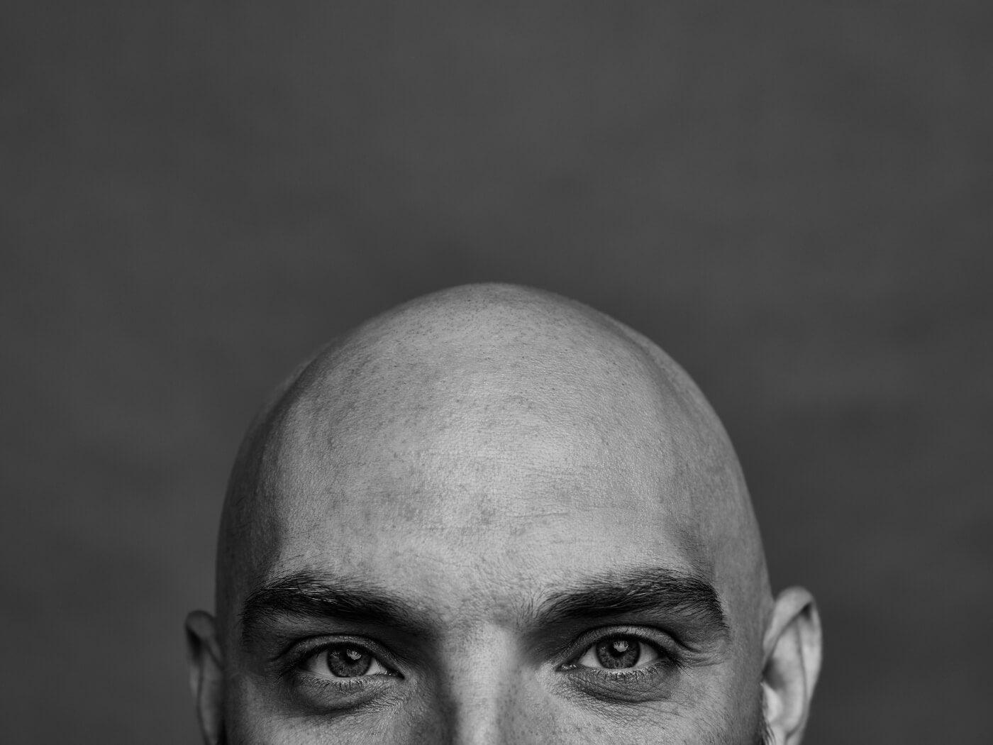 Understanding Male Baldness: Genes or Diet? - OBRO